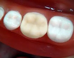 Making Temporary Crowns: “Hands-On Program”  [AGD Code #269]